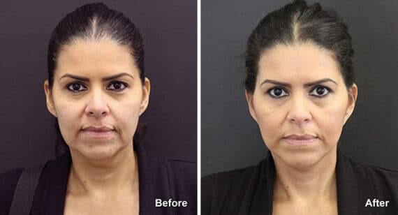 Neck Lift Before and After Photos in Princeton, NJ, Patient 7221