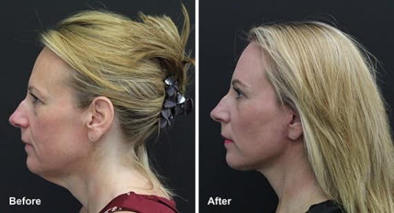 Neck Lift Before and After Photos in Princeton, NJ, Patient 7231