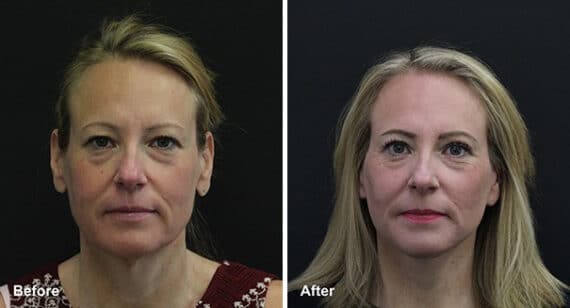 Neck Lift Before and After Photos in Princeton, NJ