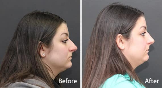 Rhinoplasty Before and After Photos in Princeton, NJ, Patient 7238