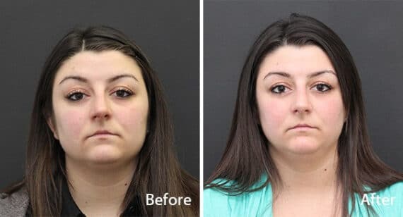 Rhinoplasty Before and After Photos in Princeton, NJ, Patient 7238