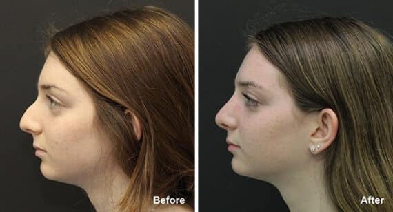 Rhinoplasty Before and After Photos in Princeton, NJ, Patient 7248