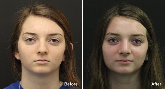 Rhinoplasty Before and After Photos in Princeton, NJ, Patient 7248