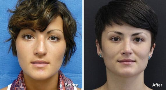 Rhinoplasty Before and After Photos in Princeton, NJ, Patient 7255