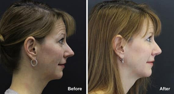 Rhinoplasty Before and After Photos in Princeton, NJ, Patient 7285