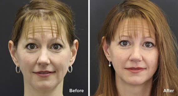 Rhinoplasty Before and After Photos in Princeton, NJ, Patient 7285