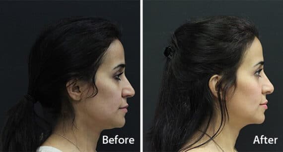 Rhinoplasty Before and After Photos in Princeton, NJ, Patient 7295