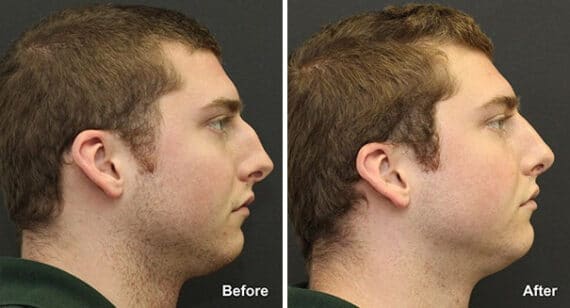 Rhinoplasty Before and After Photos in Princeton, NJ, Patient 7315