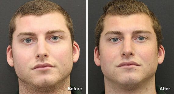 Rhinoplasty Before and After Photos in Princeton, NJ, Patient 7315