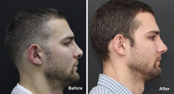 Rhinoplasty Before and After Photos in Princeton, NJ, Patient 7325