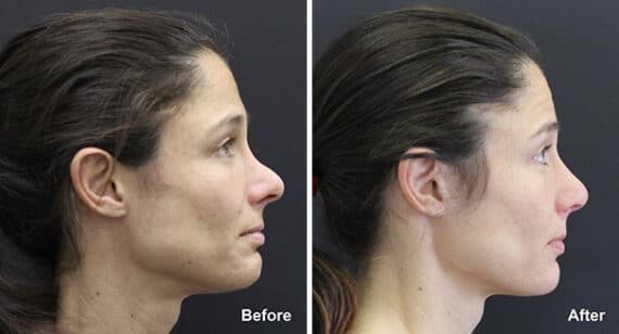 Rhinoplasty Before and After Photos in Princeton, NJ, Patient 7335