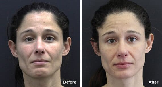 Rhinoplasty Before and After Photos in Princeton, NJ, Patient 7335