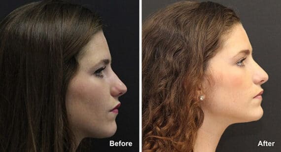 Rhinoplasty Before and After Photos in Princeton, NJ, Patient 7345