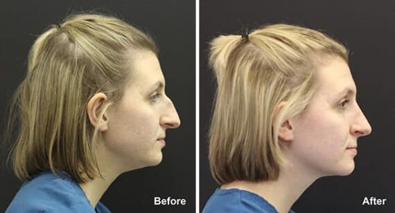 Rhinoplasty Before and After Photos in Princeton, NJ, Patient 7356