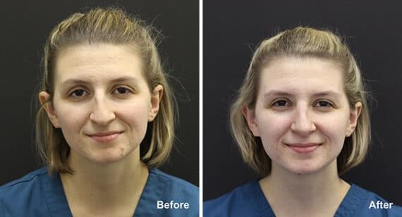 Rhinoplasty Before and After Photos in Princeton, NJ, Patient 7356