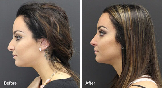 Rhinoplasty Before and After Photos in Princeton, NJ, Patient 7366