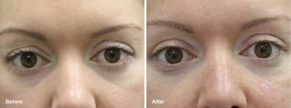 Upper Eyelid Surgery Before and After Photos in Princeton, NJ, Patient 7439