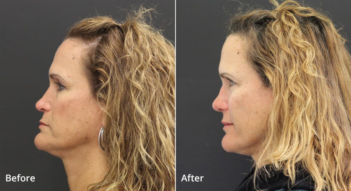 Rhinoplasty Before and After Photos in Princeton, NJ, Patient 7637
