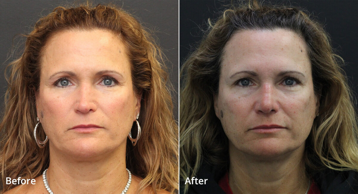 Rhinoplasty Before and After Photos in Princeton, NJ, Patient 7637