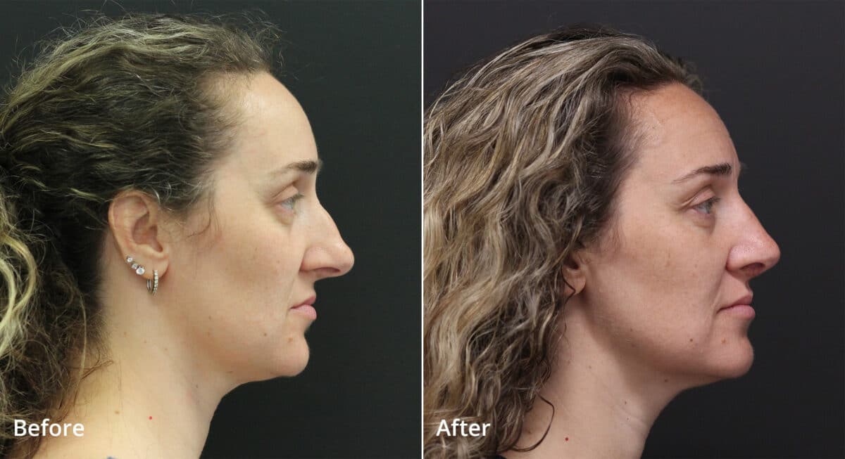 Rhinoplasty Before and After Photos in Princeton, NJ, Patient 7644