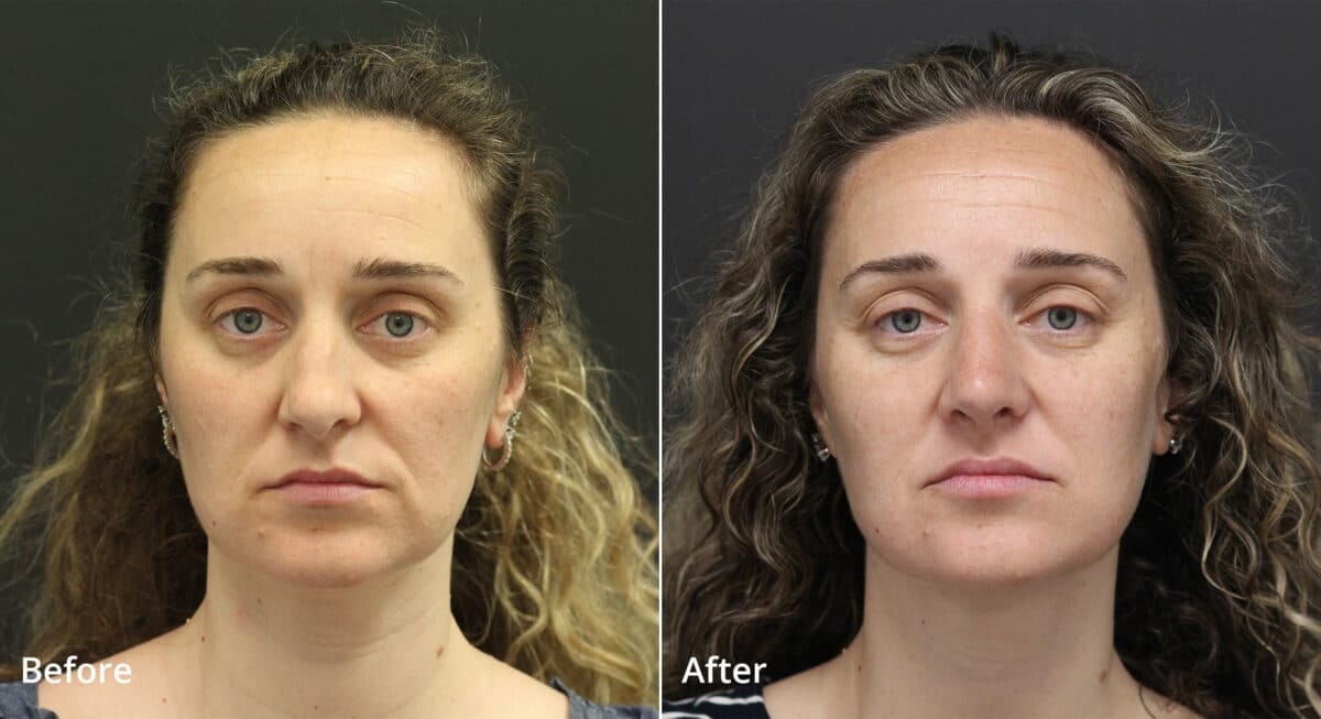 Rhinoplasty Before and After Photos in Princeton, NJ, Patient 7644