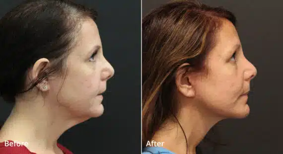 Neck Lift Before and After Photos in Princeton, NJ, Patient 7676