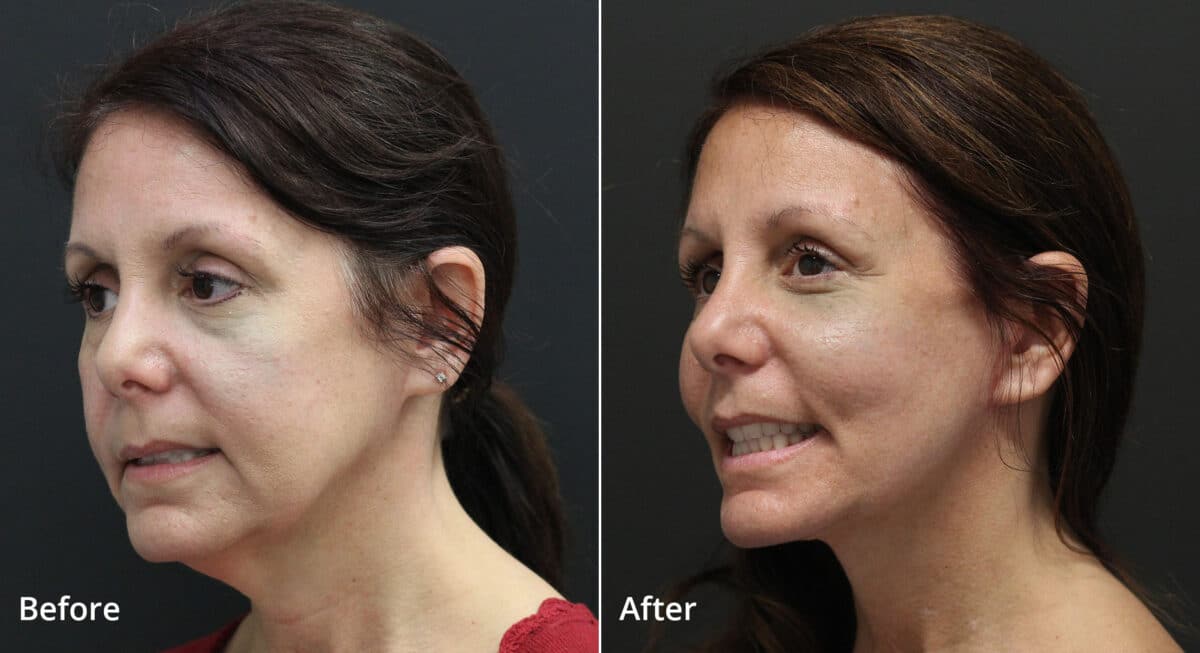 Neck Lift Before and After Photos in Princeton, NJ, Patient 7676