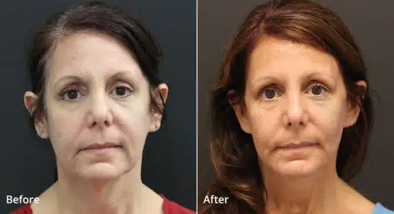 Neck Lift Before and After Photos in Princeton, NJ, Patient 7676