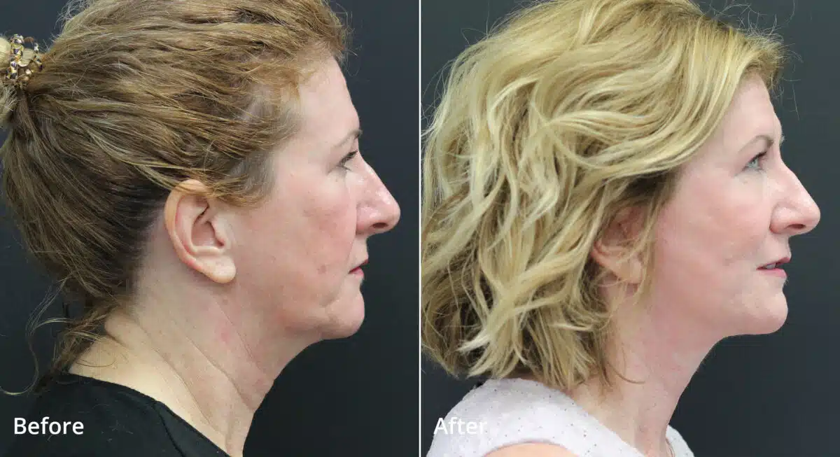 Neck Lift Before and After Photos in Princeton, NJ, Patient 7691