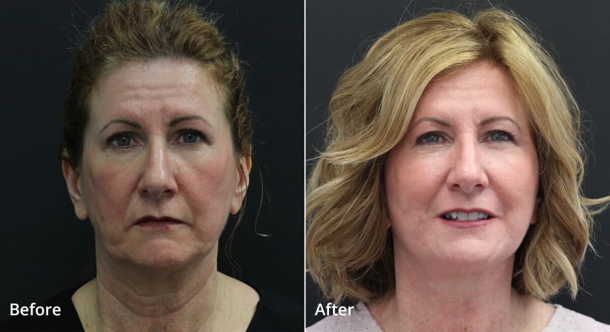 Neck Lift Before and After Photos in Princeton, NJ, Patient 7691