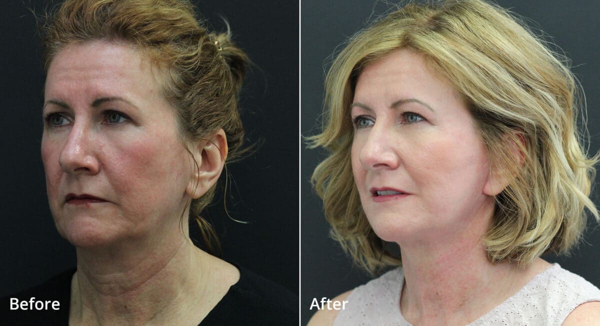 Neck Lift Before and After Photos in Princeton, NJ, Patient 7691