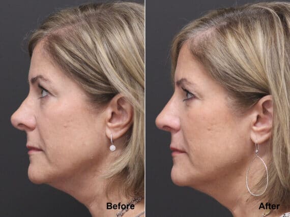 Rhinoplasty Before and After Photos in Princeton, NJ, Patient 7797