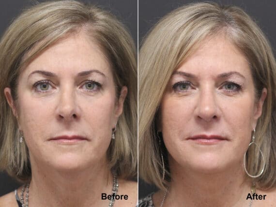 Rhinoplasty Before and After Photos in Princeton, NJ, Patient 7797