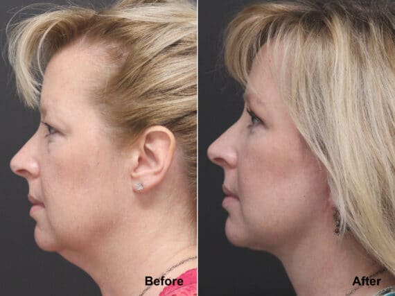 Neck Lift Before and After Photos in Princeton, NJ, Patient 7811