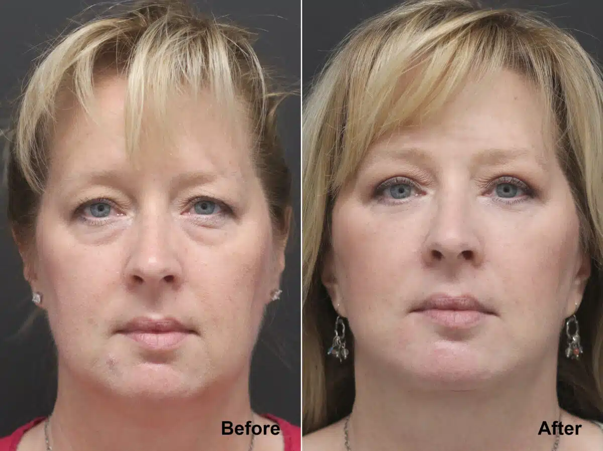 Neck Lift Before and After Photos in Princeton, NJ, Patient 7811