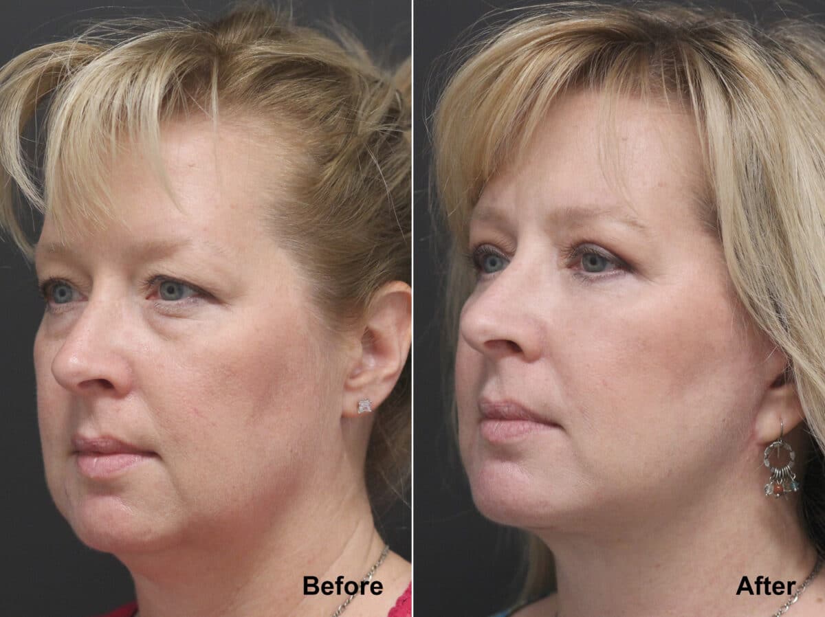 Neck Lift Before and After Photos in Princeton, NJ, Patient 7811