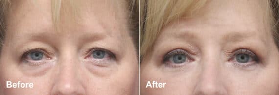 Upper and Lower Eyelid Surgery Before and After Photos in Princeton, NJ, Patient 7839