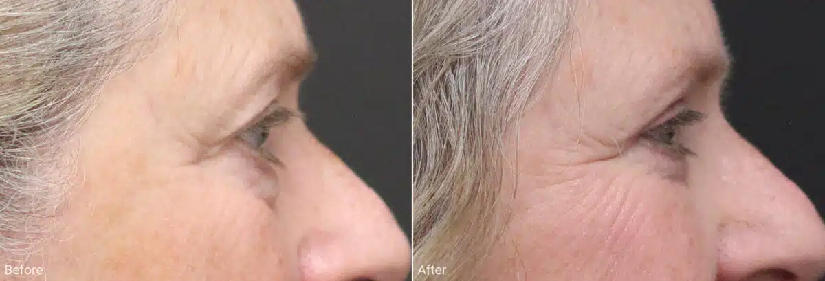 Upper and Lower Eyelid Surgery Before and After Photos in Princeton, NJ, Patient 7859