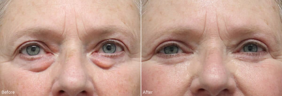 Upper and Lower Eyelid Surgery Before and After Photos in Princeton, NJ, Patient 7859