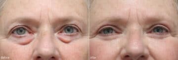 Upper and Lower Eyelid Surgery Before and After Photos in Princeton, NJ, Patient 7859