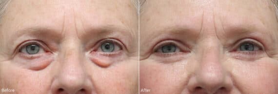 Upper and Lower Eyelid Surgery Before and After Photos in Princeton, NJ, Patient 7859