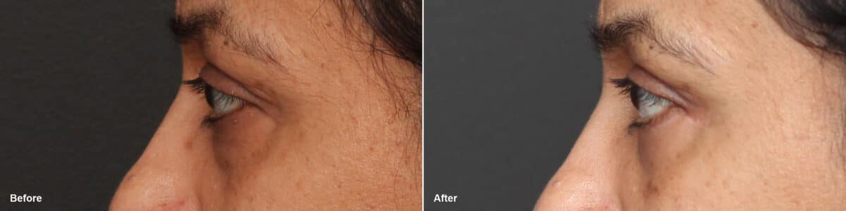 Lower Eyelid Surgery Before and After Photos in Princeton, NJ, Patient 8699