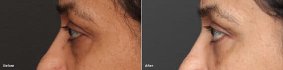 Lower Eyelid Surgery Before and After Photos in Princeton, NJ, Patient 8699