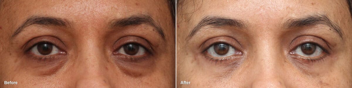 Lower Eyelid Surgery Before and After Photos in Princeton, NJ, Patient 8699