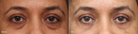Lower Eyelid Surgery Before and After Photos in Princeton, NJ, Patient 8699