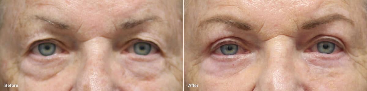 Upper and Lower Eyelid Surgery Before and After Photos in Princeton, NJ, Patient 8733