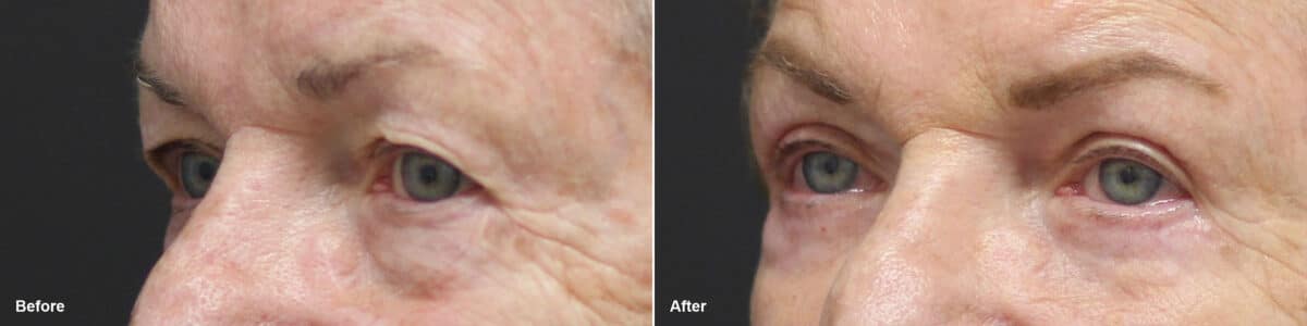 Upper and Lower Eyelid Surgery Before and After Photos in Princeton, NJ, Patient 8733