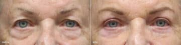 Upper and Lower Eyelid Surgery Before and After Photos in Princeton, NJ, Patient 8733