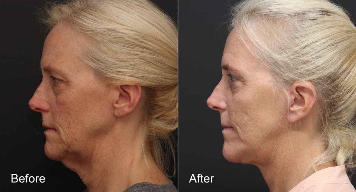 Neck Lift Before and After Photos in Princeton, NJ, Patient 8763