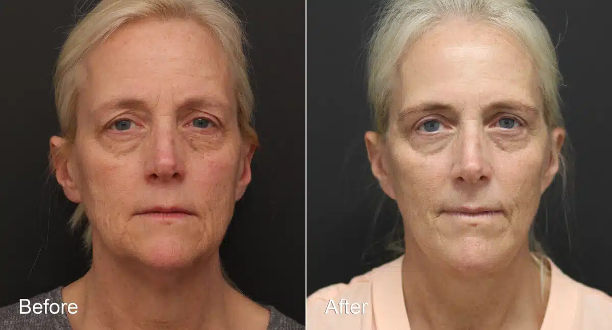 Neck Lift Before and After Photos in Princeton, NJ, Patient 8763